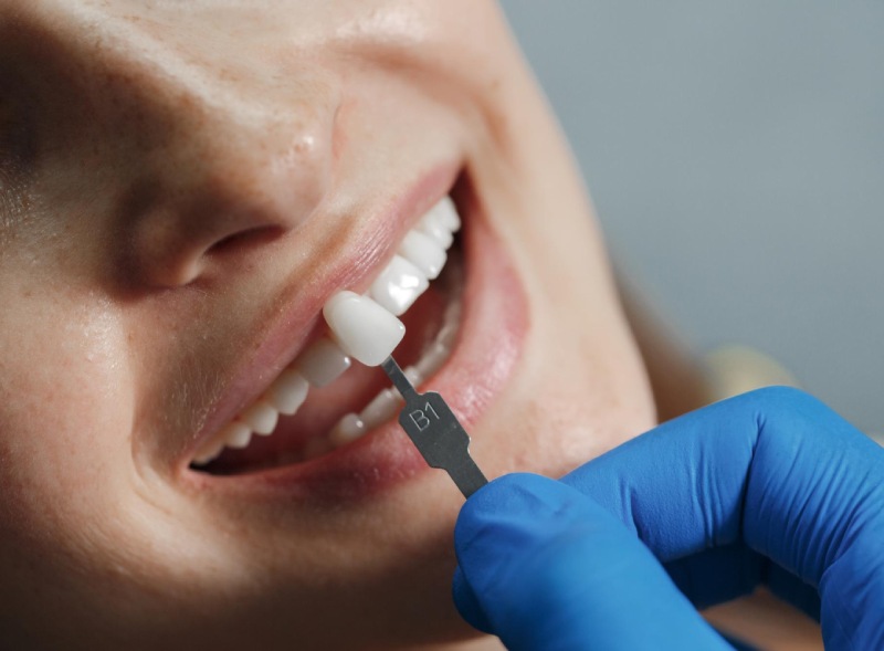 ¿Qué son las carillas dentales?